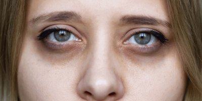 Dermatologist Explains Common Causes of Dark Circles and Home Remedies to Manage Them