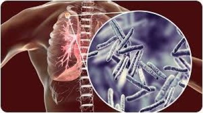 लखनऊ: फरवरी से फिर चलेगा 100 दिन का सघन टीबी रोगी खोज अभियान, तकनीक और जनभागीदारी पर यूपी सरकार का जोर