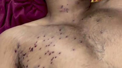 Hospital Record Mentions Pellet Wounds as Police Reject Allegations of Pellet Gun Use During NEET Protest