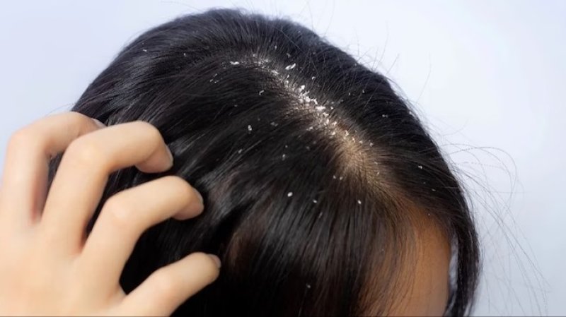 Not All Dandruff Is the Same: Experts Highlight Different Types and the Need for Targeted Treatment