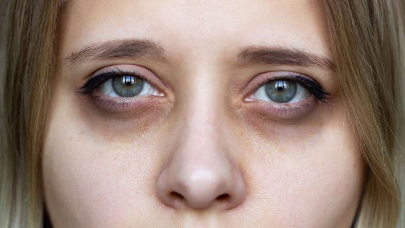 Dark Circles Not Just About Sleep: Experts Highlight Six Key Causes and Targeted Treatments
